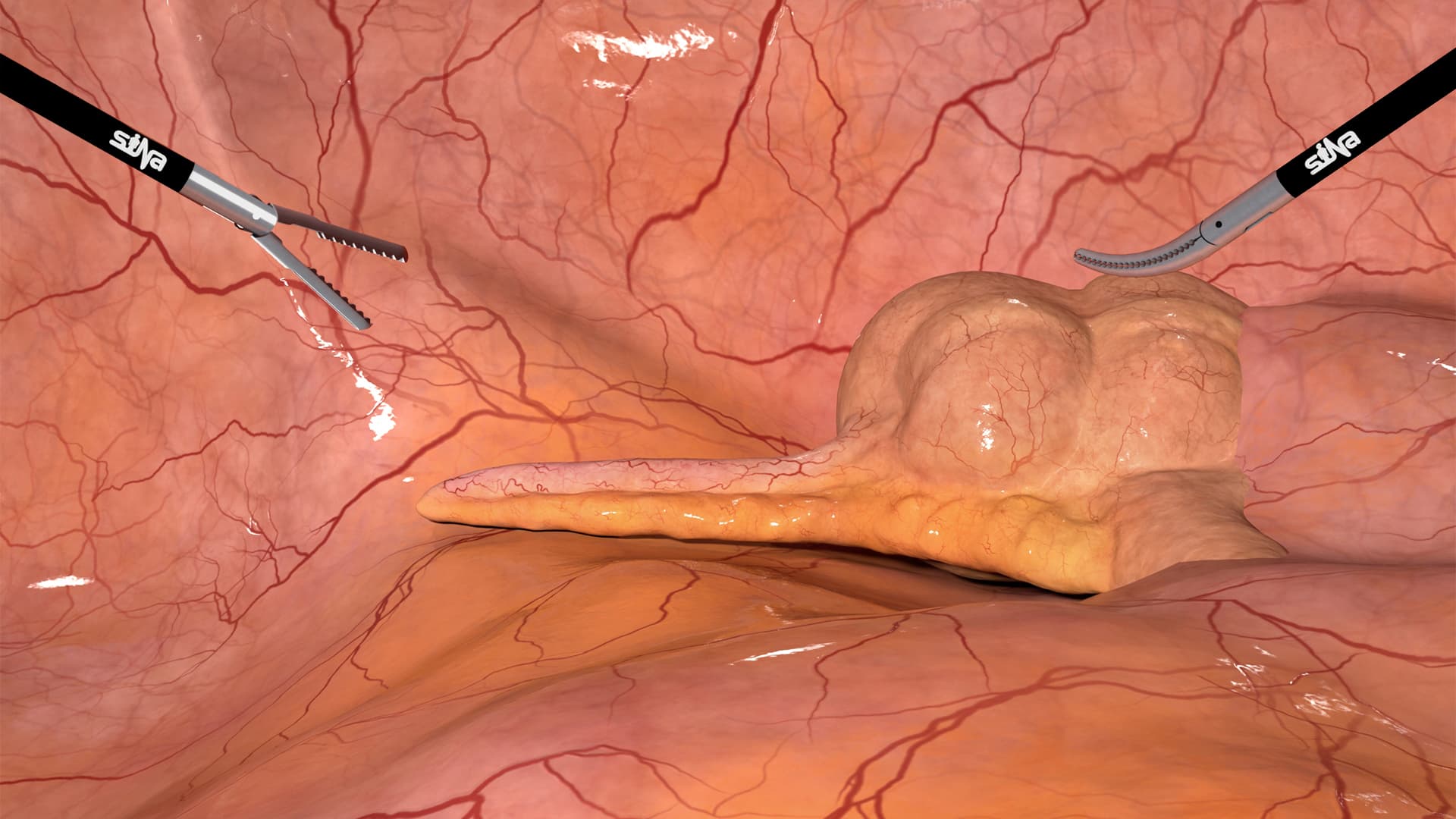 Appendectomy