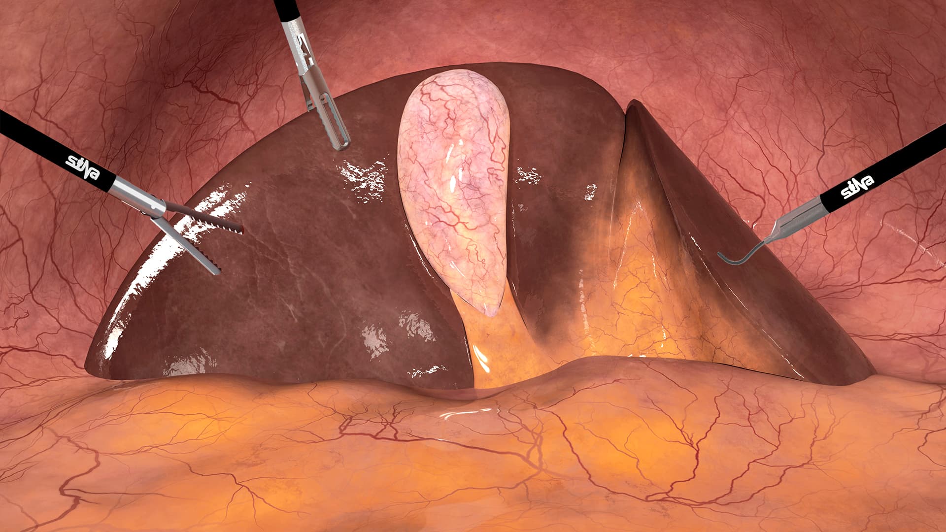 Cholecystectomy