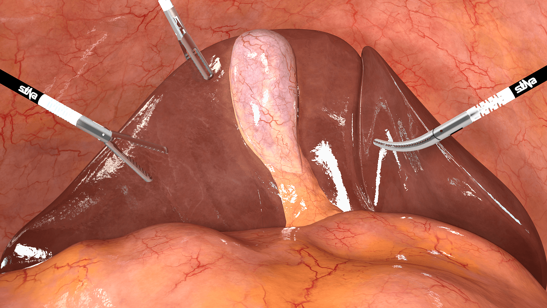 Cholecystectomy