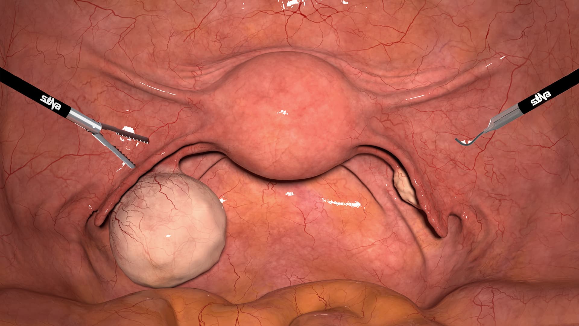 Dermoid Cyst
