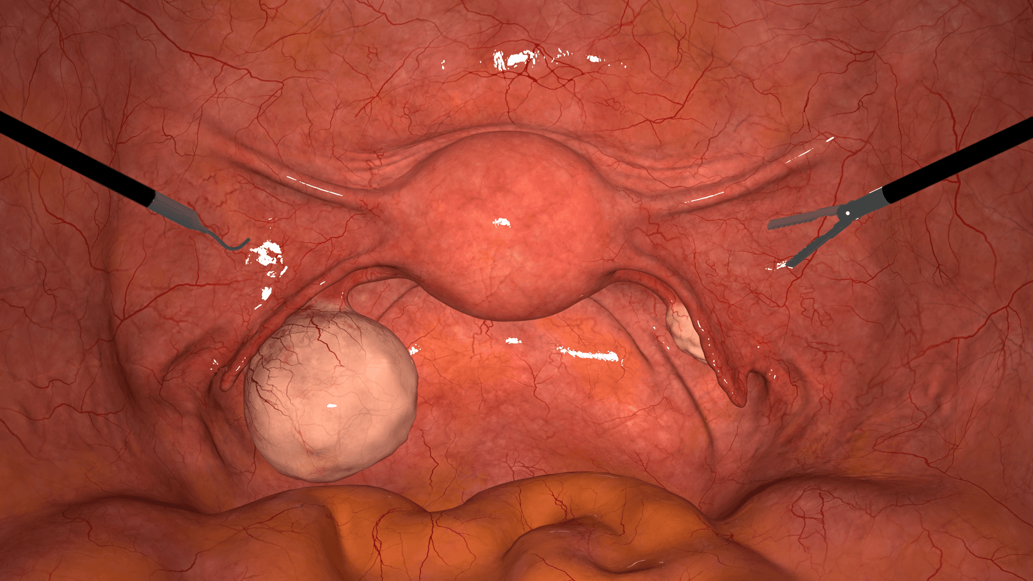 Dermoid Cyst