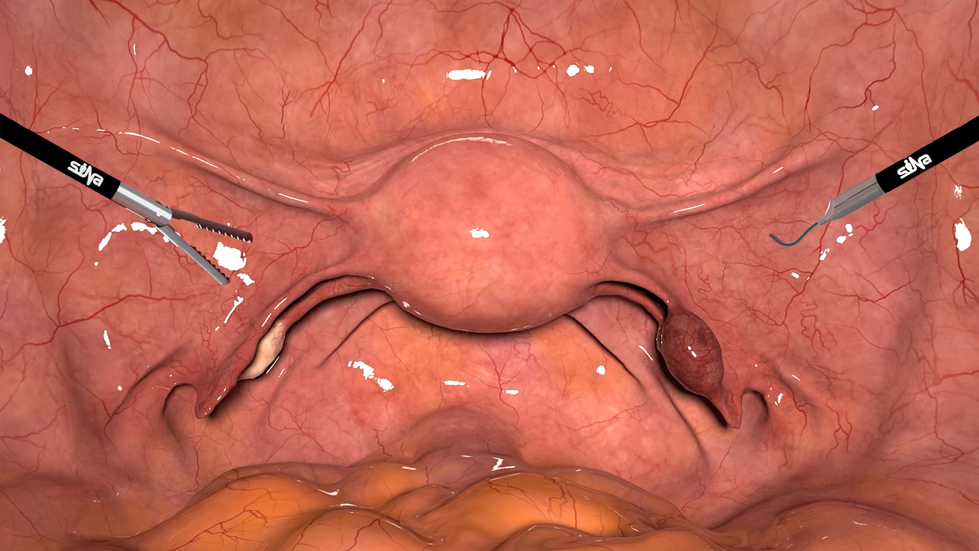 Salpingostomy