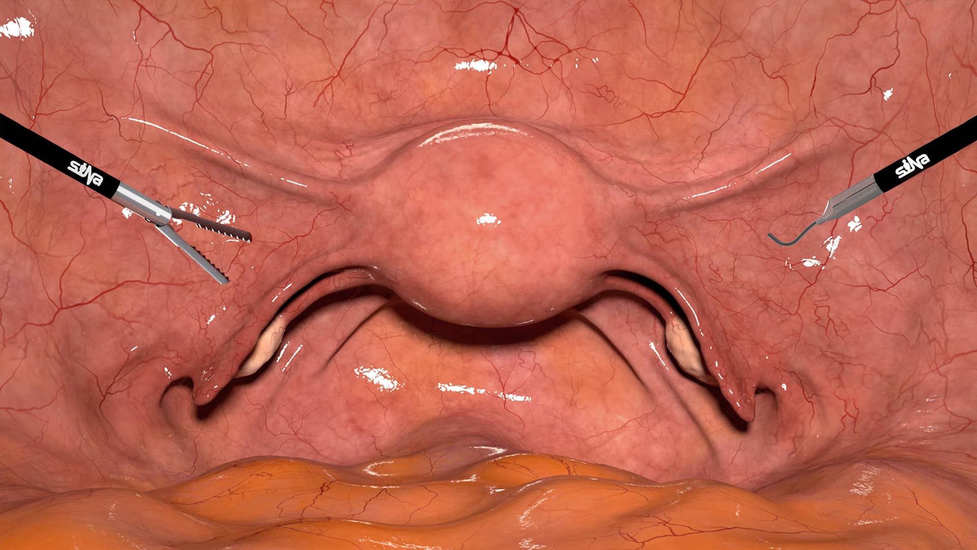 Hysterectomy