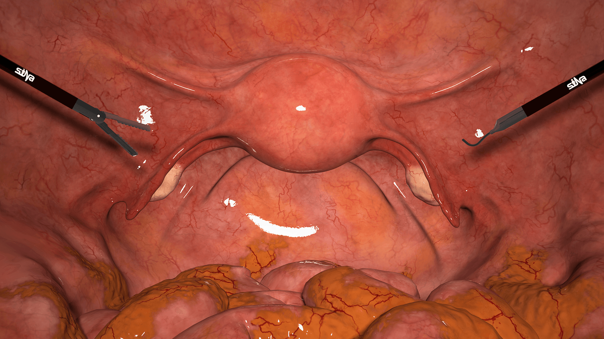 Hysterectomy