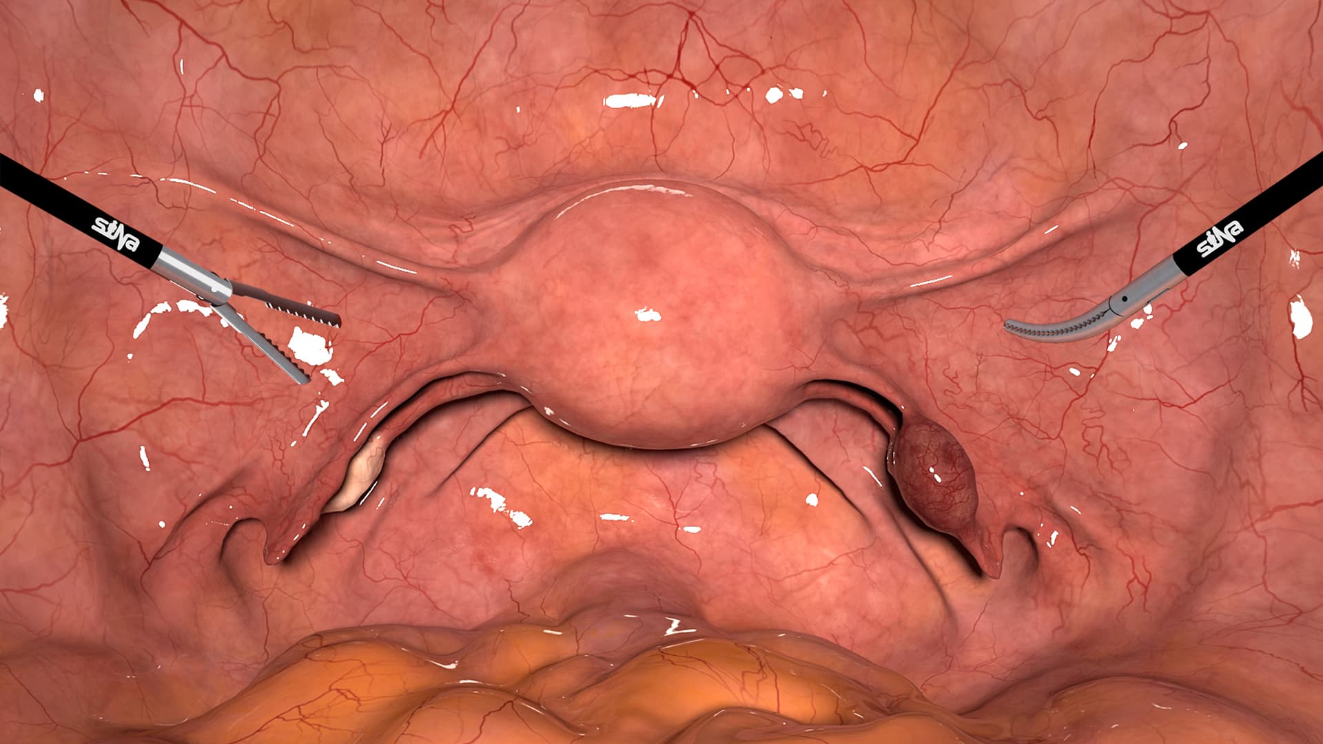 Salpingectomy